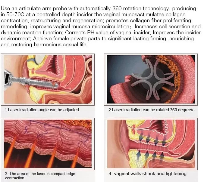 Continuous Interval Ultra Pulse RF Fractional CO2 Laser For Fractional Skin Resurfacing