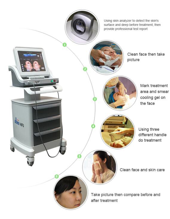 hifu machine / high intensity focused ultrasound hifu for wrinkle removal / hifu face lift