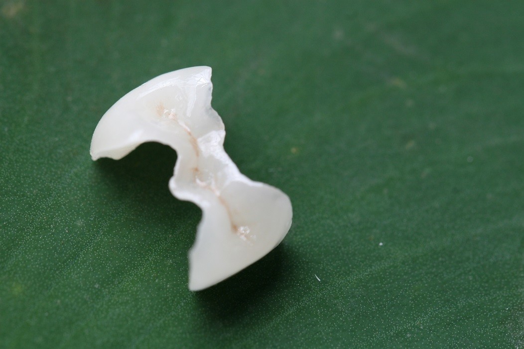 Onlay And Inlay Esthetic Artificial EMAX Dental Crown