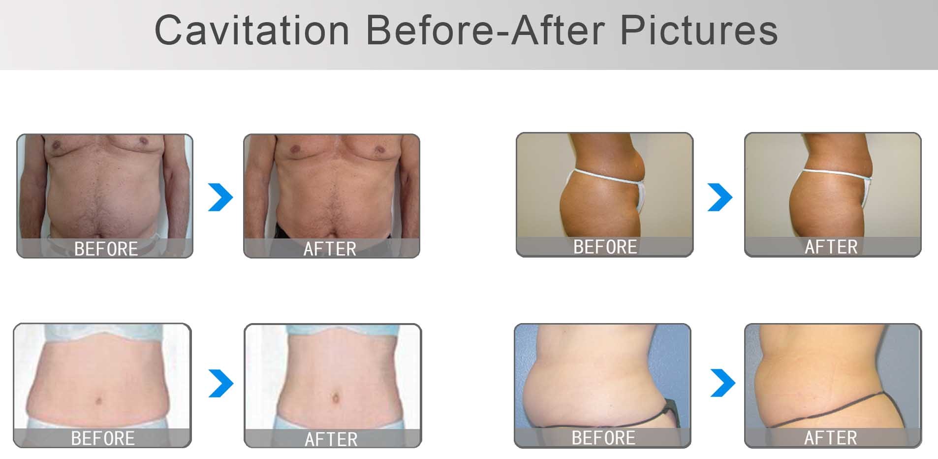 Nubway High power new cavitation rf vacuum slimming machine ultrasound cavitation machine for body shaping