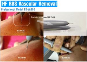 Quality Professional Vascular Removal Machine , Spider Vein Removal Machine High Frequency wholesale