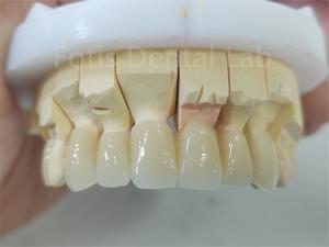 Quality Dental Product Zirconia Layered With Porcelain Easy Maintenance wholesale