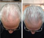 hair loss laser cap