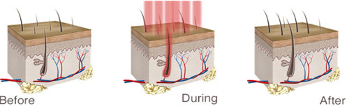 Microcurrent Probe Hair Growth Laser Comb , Low Level Laser Hair Therapy