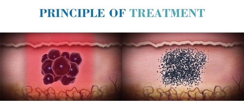 Best Effective Advanced Carbon Peeling Treatment 532nm 755nm 1064nm Picosecond 600ps Laser Tattoo Freckle Removal Machin