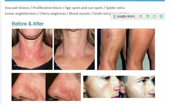 Nubway offer clinic use spider blood vessels removal vascular removal 980nm