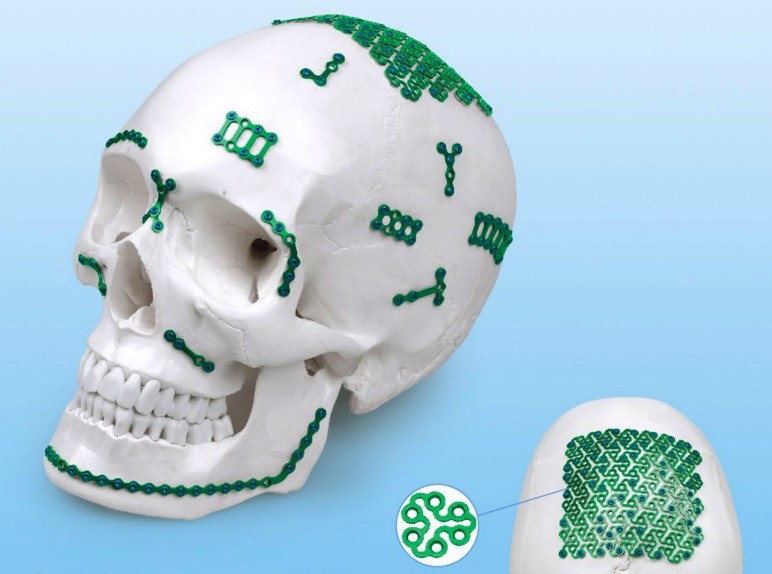 X Shaped Plates Maxillofacia Implants Used In Orthopedic Surgery