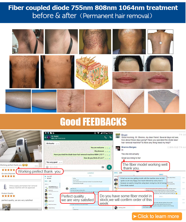 3 wavelength 808nm 755nm 1064nm fiber diode laser painless hair removal beauty laser machine price