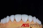 Dental Porcelain Emax Laminate Veneers Seamlessly Customized