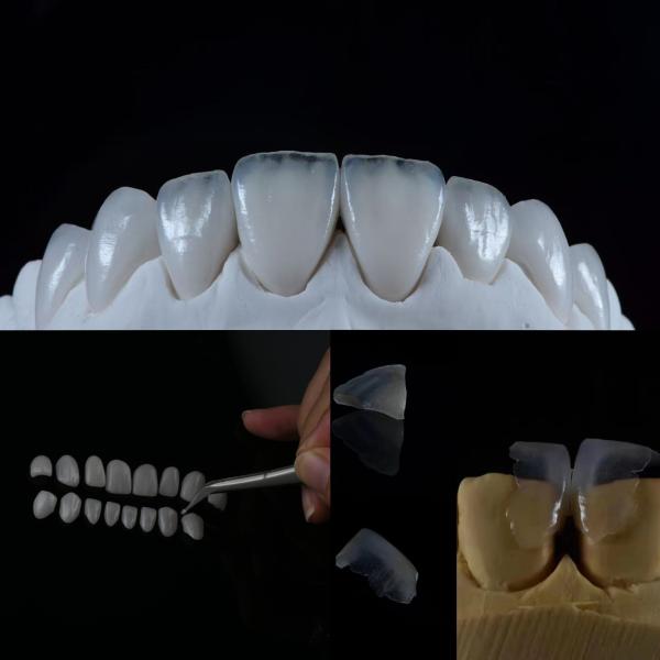 Glass Ceramic Veneer Achieve a Natural-Looking Smile with This Superior Dental