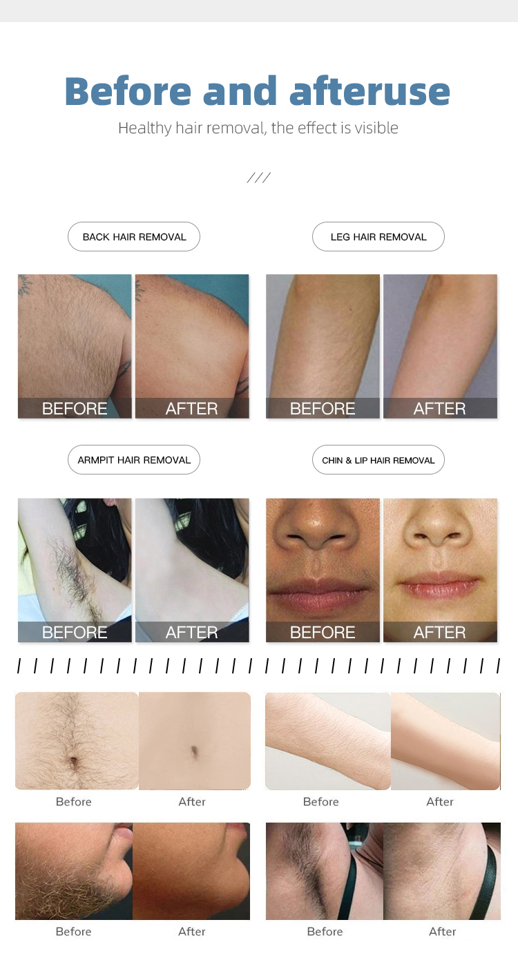 Tattoo Eyebrow Pigment Removal 808nm diode laser Fast Hair Removal Multifunctional Beauty Equipment Machine