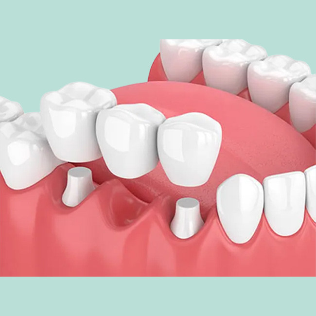 Comfortable Dental Crowns And Bridges Strong Wear Resistance Make Smile Sweeter