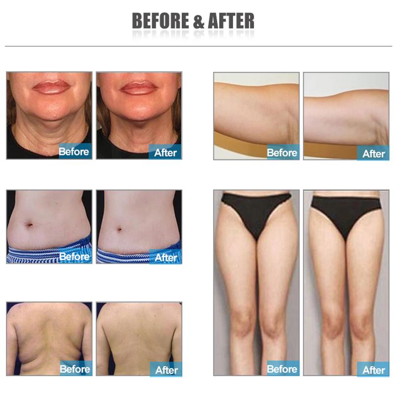Cryo+Laser+40k Cavitation for Body Face 360 Surrounding Cooling Technology Slimming Machine for Beauty Clinic Salon