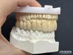Seamless PFM Porcelain Fused Metal Crown For Long Term Biocompatible Restoration