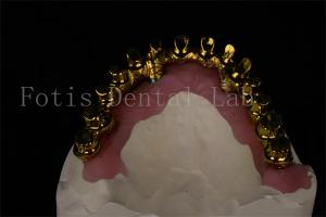 Quality Natural Looking All On 4 All On 6 Dental Implants Restores Full Chewing Ability wholesale