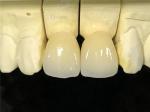 Ceramic Dental Crown,Zirconia Dental Crowns