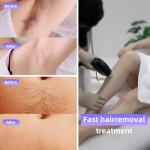 808 Diode Laser Ice Hair Removal Machine 4 Wavelengths 1064nm Changeable Spot
