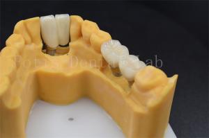 Quality Customizable Dental Restoration Implant Crown Replacement Various Sizes wholesale