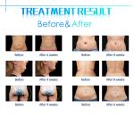 Fat freezing 360 degree criolipolisis 4 handles liposuction belly fat reducing