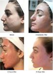 Salon CO2 Fractional Laser Machine Vaginal Tightening Skin Resurfacing Beauty