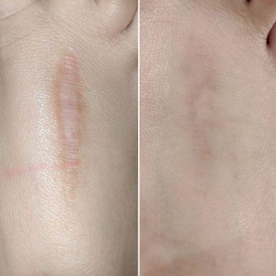 40w 60W Fractional CO2 Laser Machine For Wrinkle Removal Stretch Mark Scar Removal Tightening