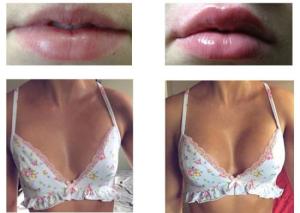 Quality Breast Enlargement Injection Filler Hyaluronic Acid Implant Lip Injections Dermal Filler wholesale