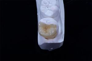 Quality Dental Crown Composite Inlays And Onlays Restoration Customized Shape wholesale