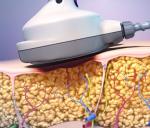Medical hifu ultrashape slimming machine/hifu/hifu ultrashape