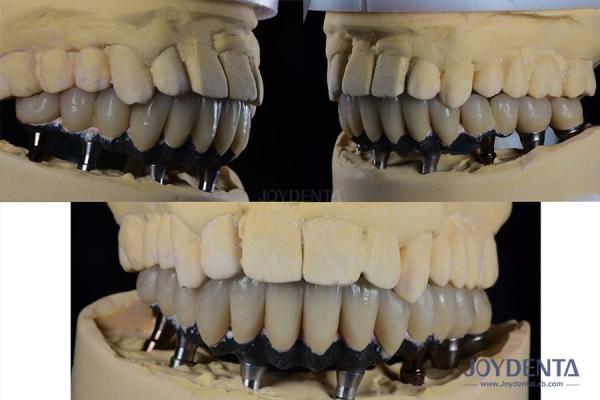 Titanium Multiple Teeth Dental Implant Prosthetic Surgery External Hexagon