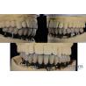 Buy cheap Titanium Multiple Teeth Dental Implant Prosthetic Surgery External Hexagon from wholesalers