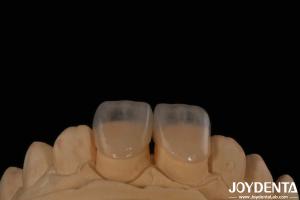 Quality Eco Friendly Micro Dental Teeth Veneer 0.2mm Thickness Smooth Texture wholesale
