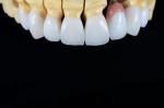 OEM Veneers Dental E-Max Crowns Stain Resistance Minimally Invasive