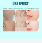 Commercial Q Switched ND YAG Laser Machine 1064 532 1320nm Nd Yag Tattoo Removal