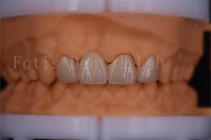 Quality FDA Certified Digital Crowns Bridge Dentrues Design Customizable Size wholesale