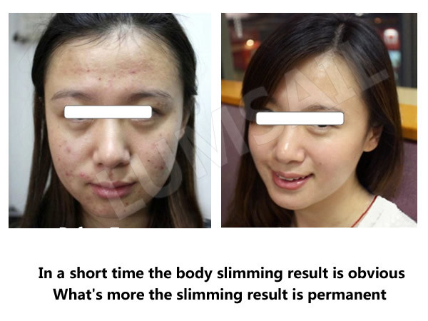 Skin Rejuvenation PDT LED Light Therapy Machine , Blue And Red Light Therapy Devices
