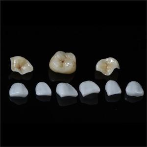 Quality Tooth All Porcelain IPS Emax Inlay Onlay Veneer Aesthetic In Dentistry wholesale