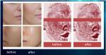 Salon Mesotherapy Injection Pdrn Hyaluronic Acid Skin Rejuvenating Complex