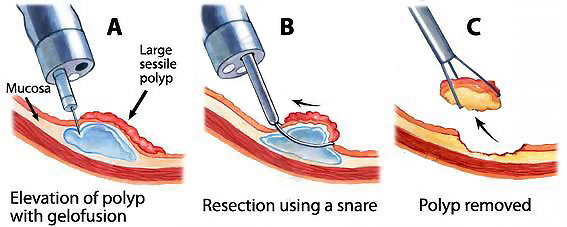Hot Selling Disposable Polypectomy Snare for Polyp Retrieval