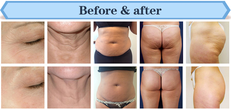 Factory Supplier Vacuum RF Cavitation Skin Tightening Body Slimming Machine With Medical CE