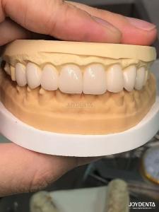 Quality Customized Shades To Match Natural Teeth Biocompatible And Stain Resistant Dental Veneers wholesale