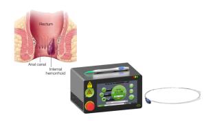 Quality 15 Watts Laser Treatment Machine Painless Hemorrhoid Removal 1470 NM Diode Laser wholesale