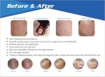 Bottom factory price!!! High quality rf skin rejuvenation vaginal tightening