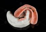Titanium Alloy Snap On Dolder Implant Bar Overdenture Polished For Natural Smile