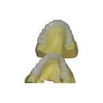 Temporary PFM Dental Crown