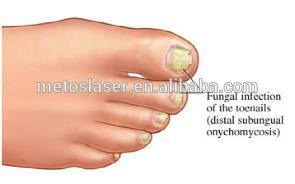 1064nm portable nail fungus laser treatment with Intelligent Alert Function