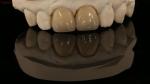Full Contour Zirconia Crown and High Aesthetic Natural Dental Bridge 5 Year
