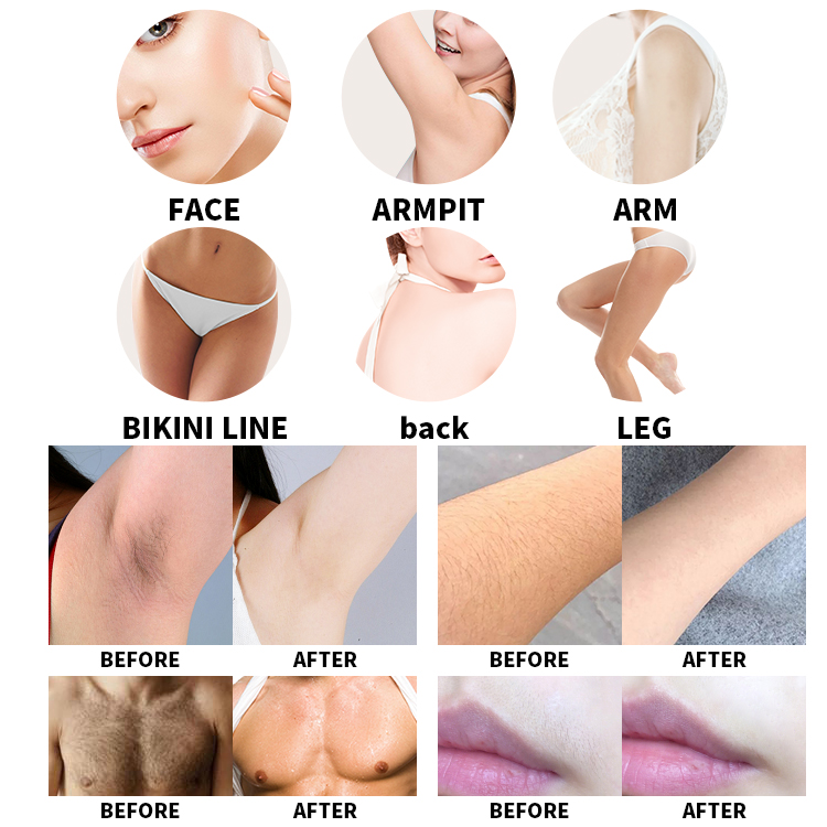 Custom Portable 808nm Diode Laser Hair Removal Machine For Face And Body