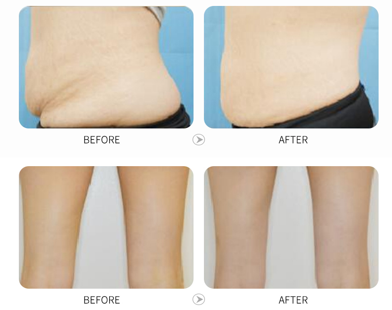 cryo fat freezing.jpg