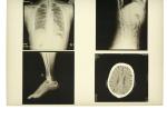28cm * 35cm Medical Film Xray Paper For KND-DRYTEC-3000 Laser Printer