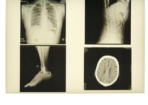 Quality 13in x 17in Degradable X Ray Diagnostic Imaging Medical Paper For Laser Printer wholesale